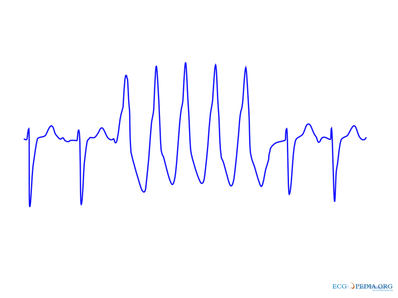 NSVT